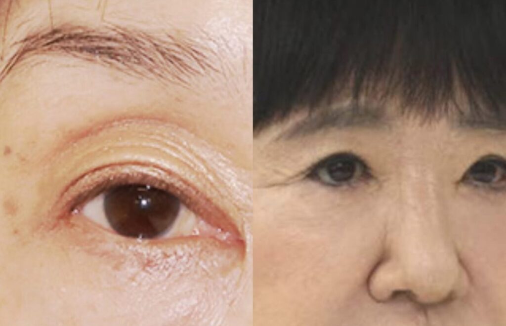 手術後の目元と和田アキ子の目の比較